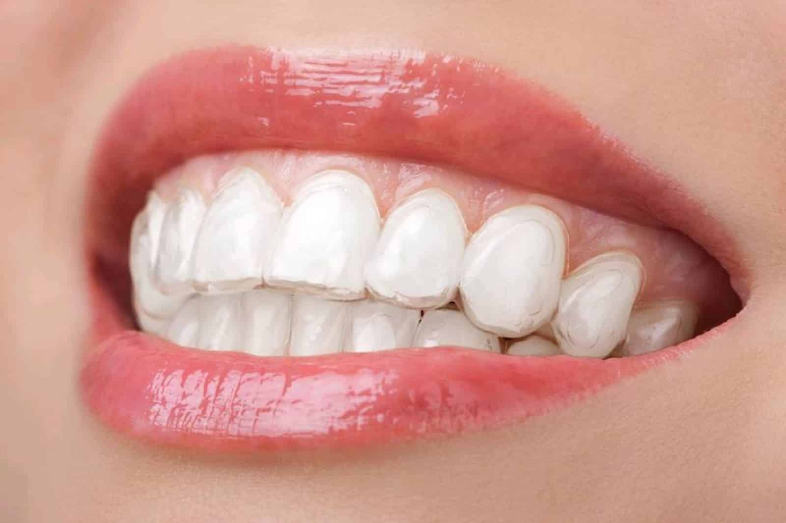 découvrez nos solutions efficaces pour redresser les dents de devant. transformez votre sourire grâce à des traitements orthodontiques adaptés à vos besoins. consultez nos experts pour un avis personnalisé et reprenez confiance en vous.